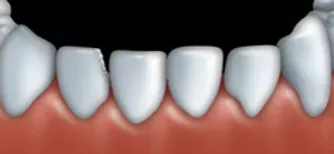 Dental bonding can be used to fix teeth that are chipped.