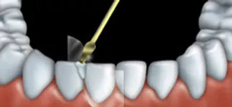 Dental bonding can be used to fix teeth that are chipped.