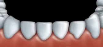 Dental bonding can be used to fix teeth that are chipped.