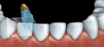 Dental bonding can be used to fix teeth that are chipped.