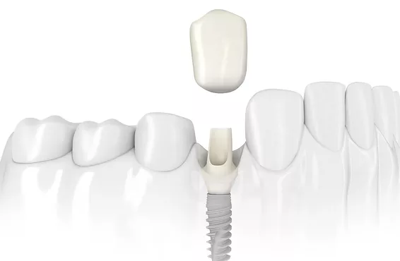 Dental bonding can be used to fix teeth that are chipped.