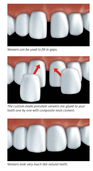 Dental bonding can be used to fix teeth that are chipped.